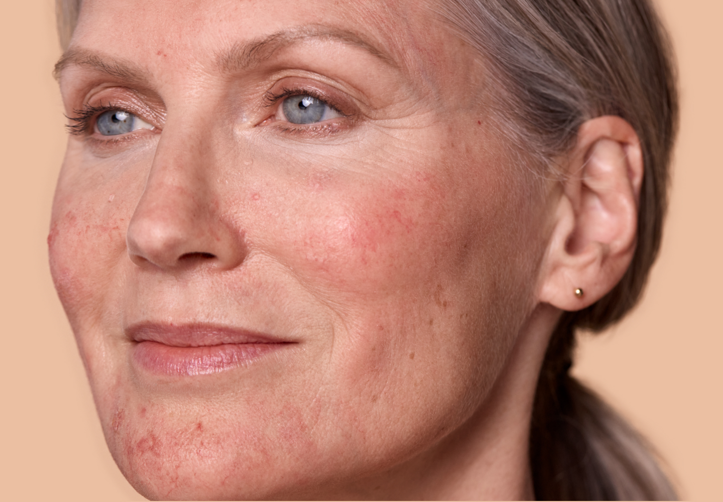 Face of a woman with rosacea in her mid-50s with slight smile