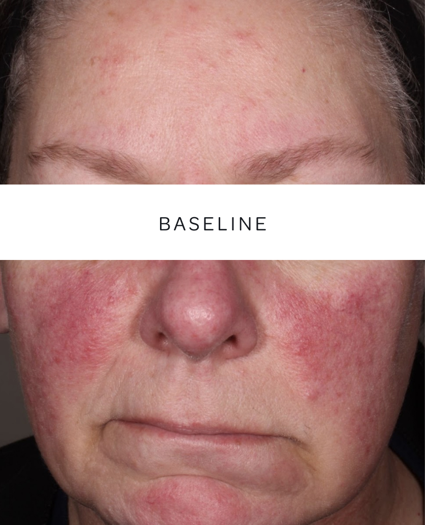 Patient 1, baseline and week 2