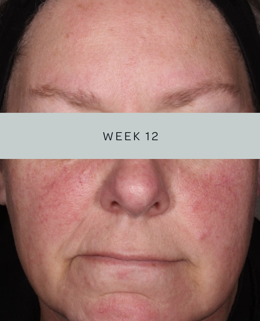 Patient 1, baseline and week 12