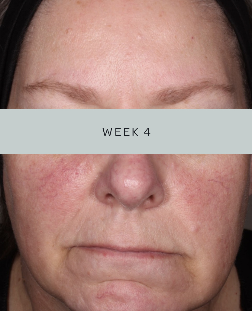 Patient 1, baseline and week 4