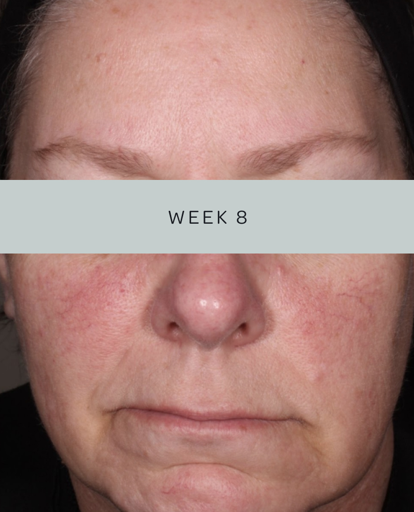 Patient 1, baseline and week 8