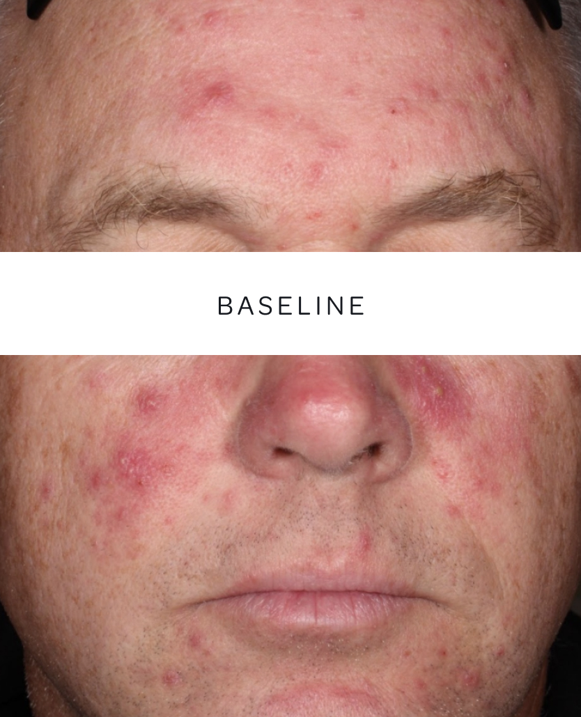 Patient 1, baseline and week 2