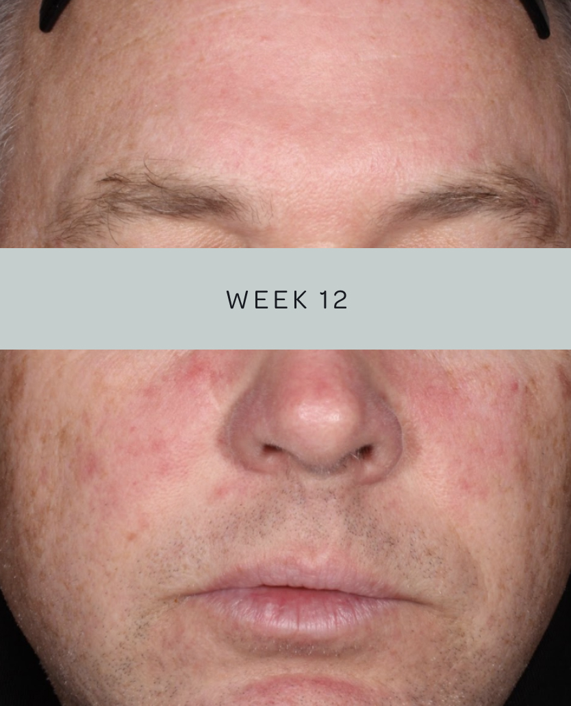 Patient 2, baseline and week 12