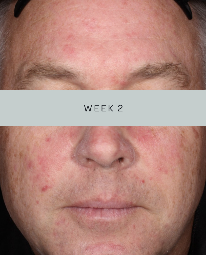 Patient 2, baseline and week 2