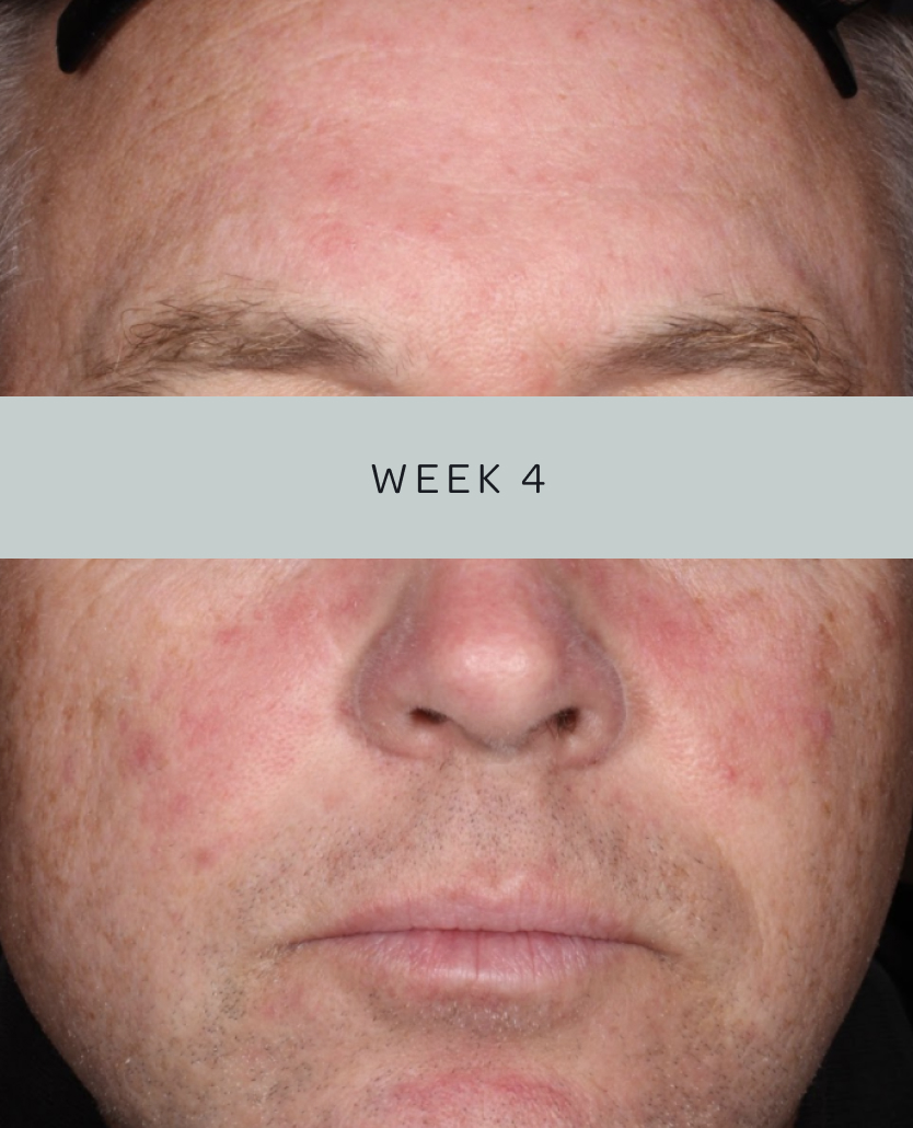 Patient 2, baseline and week 4