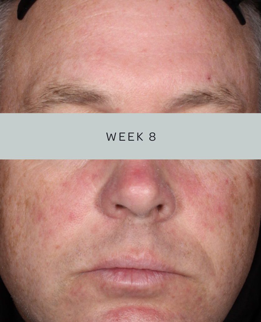 Patient 2, baseline and week 8