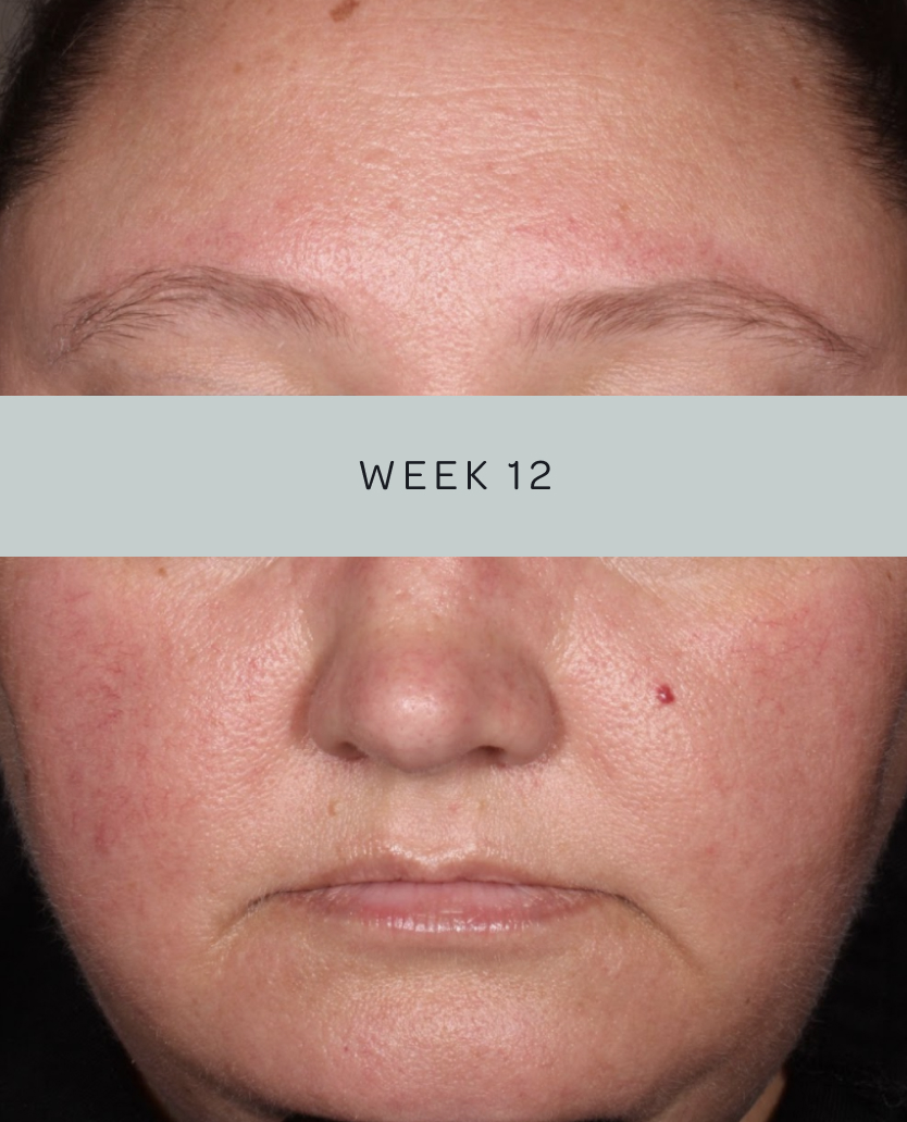 Patient 3, baseline and week 12
