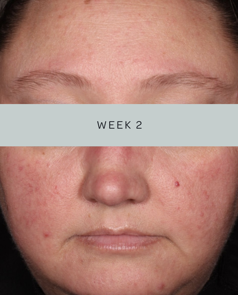 Patient 3, baseline and week 2