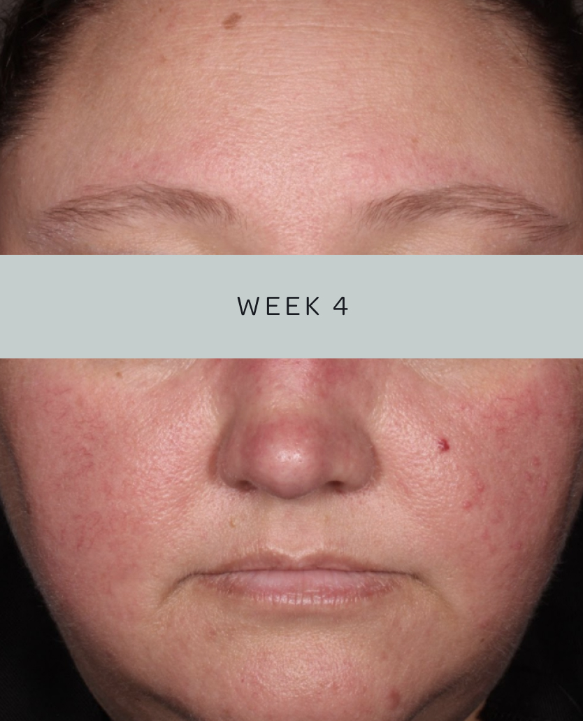 Patient 3, baseline and week 4