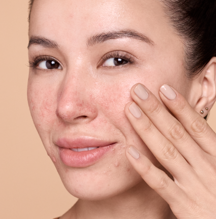 Woman with rosacea in her mid-30s touching hand to left cheek