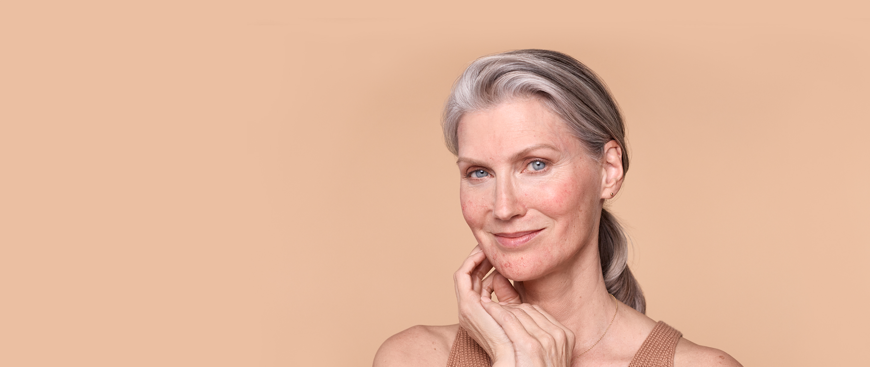 Face of a woman with rosacea in her mid-50s grinning with right hand on cheek