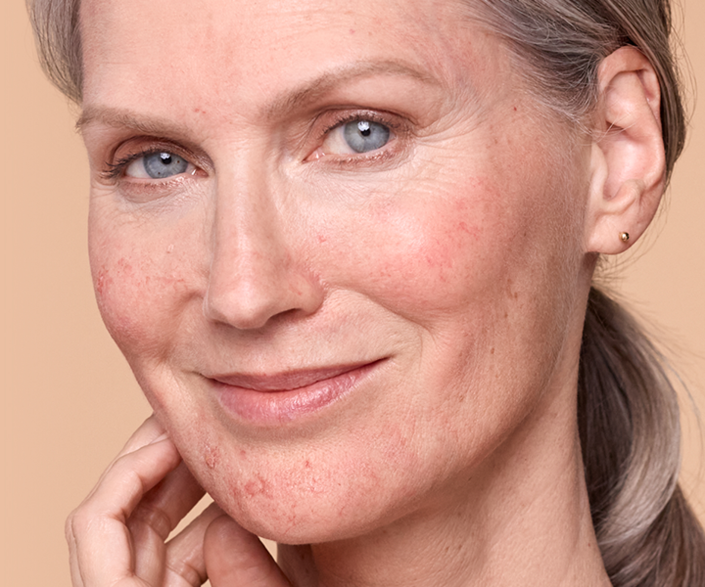 Face of a woman with rosacea in her mid-50s grinning with left hand on cheek