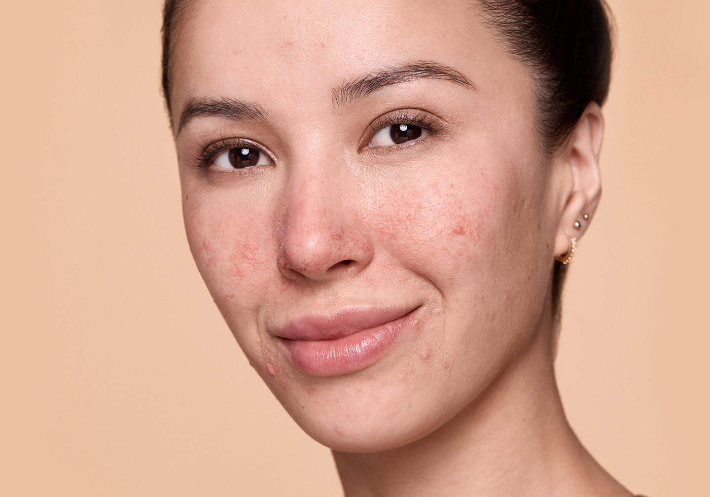 Face of a woman with rosacea in her mid-30s grinning